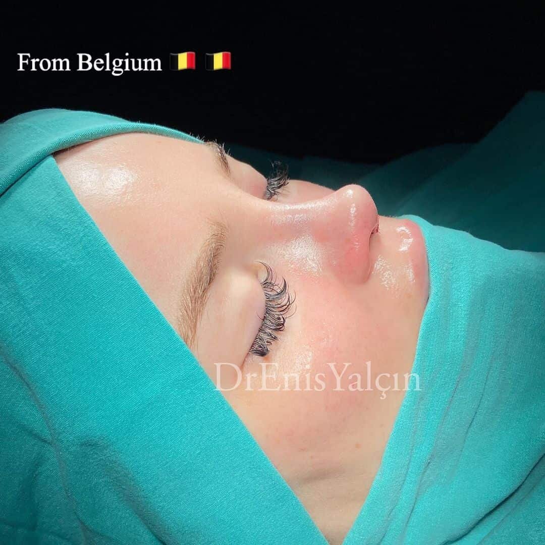 Female Rhinoplasty 1-1