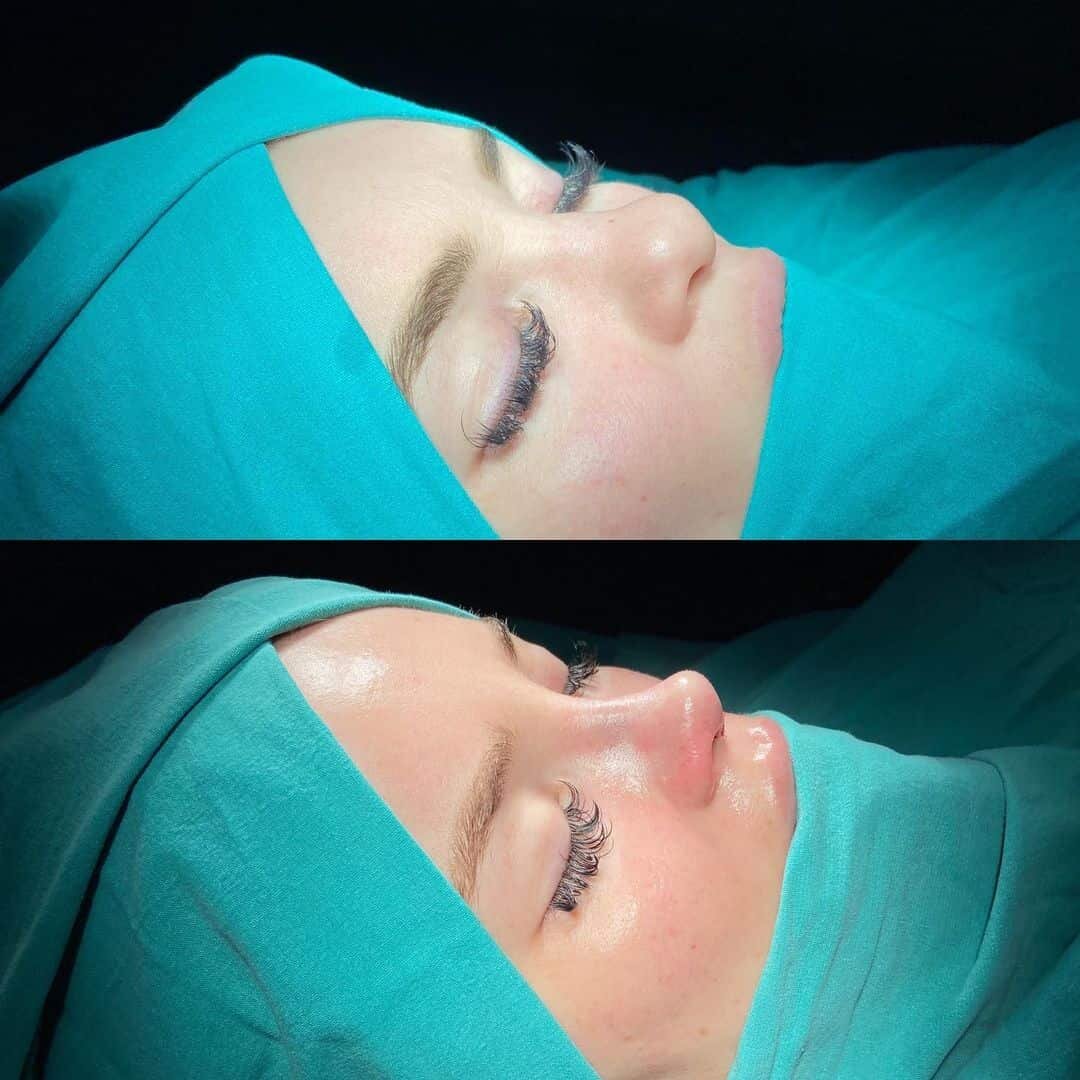Female Rhinoplasty 1-2