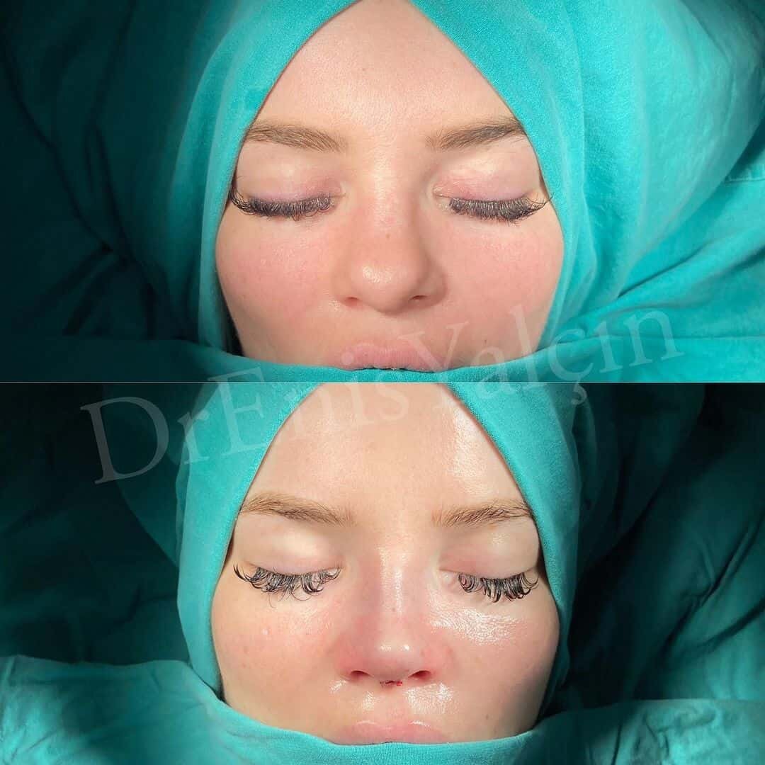 Female Rhinoplasty 1-3
