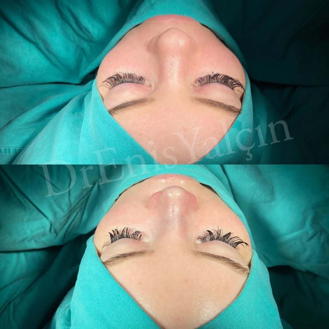 Female Rhinoplasty 1-4