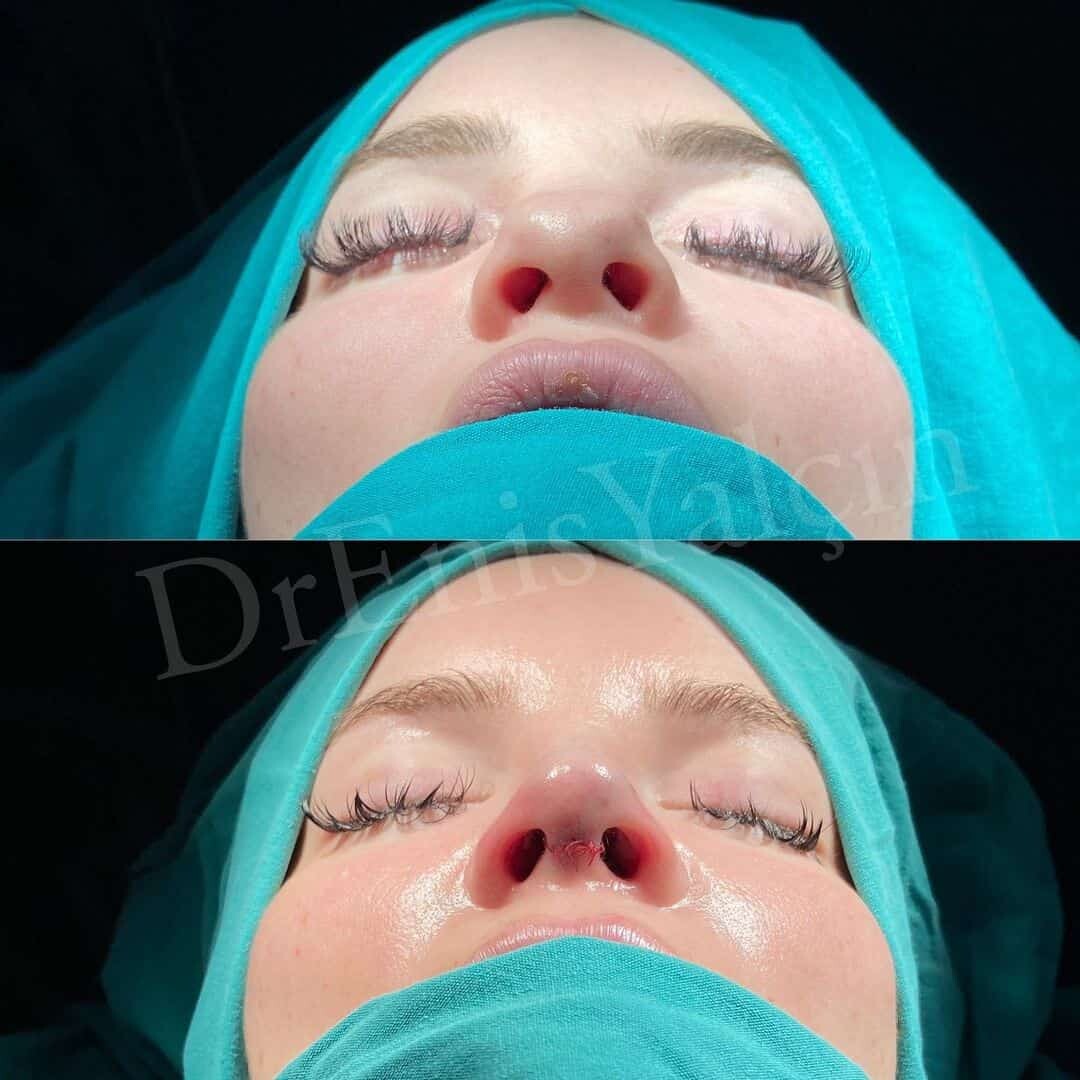 Female Rhinoplasty 1-5