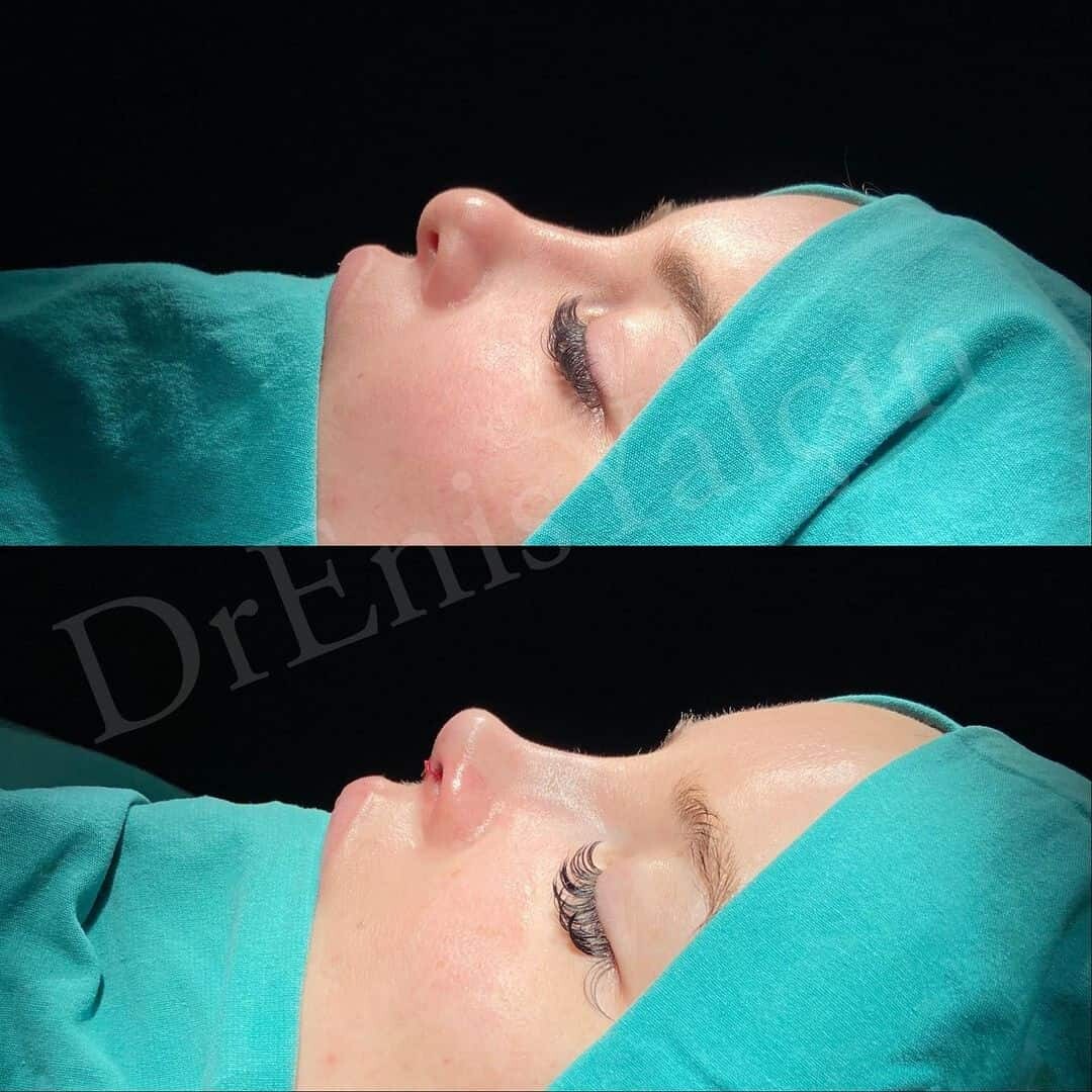 Female Rhinoplasty 1-6