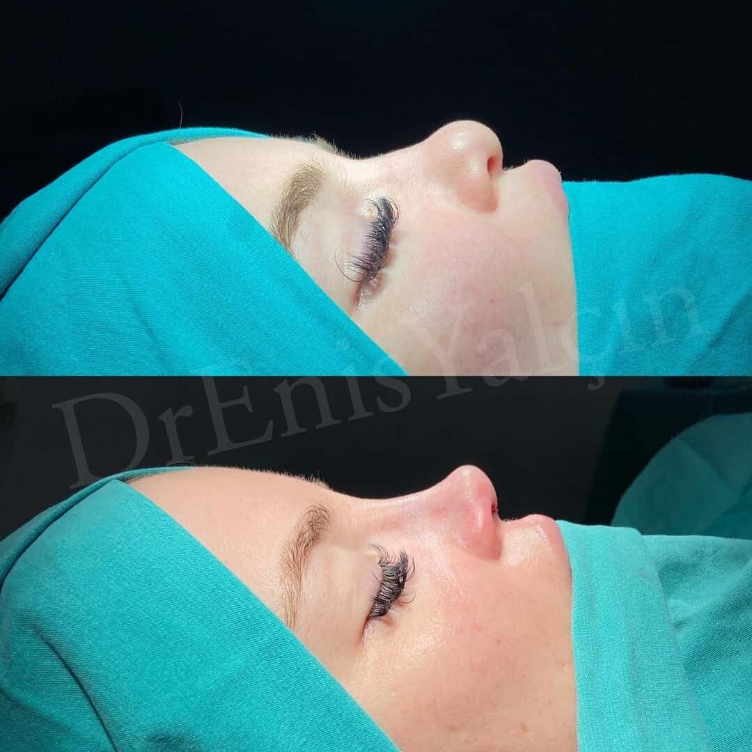 Female Rhinoplasty 1-7