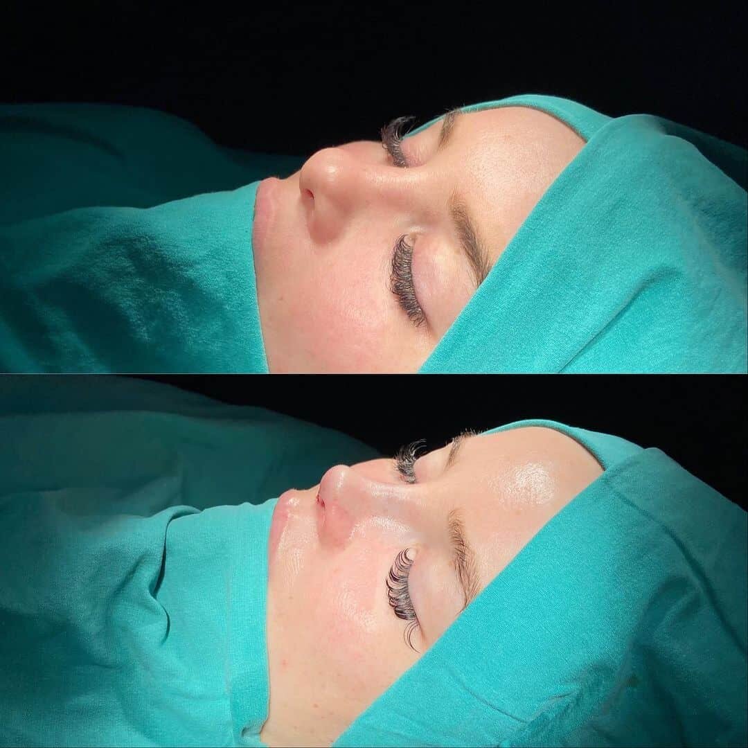 Female Rhinoplasty 1-8