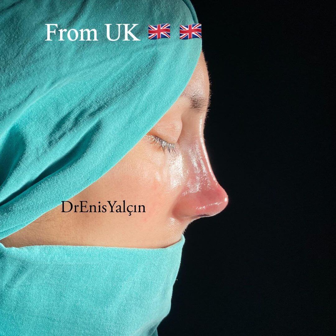 Female Rhinoplasty 2-1