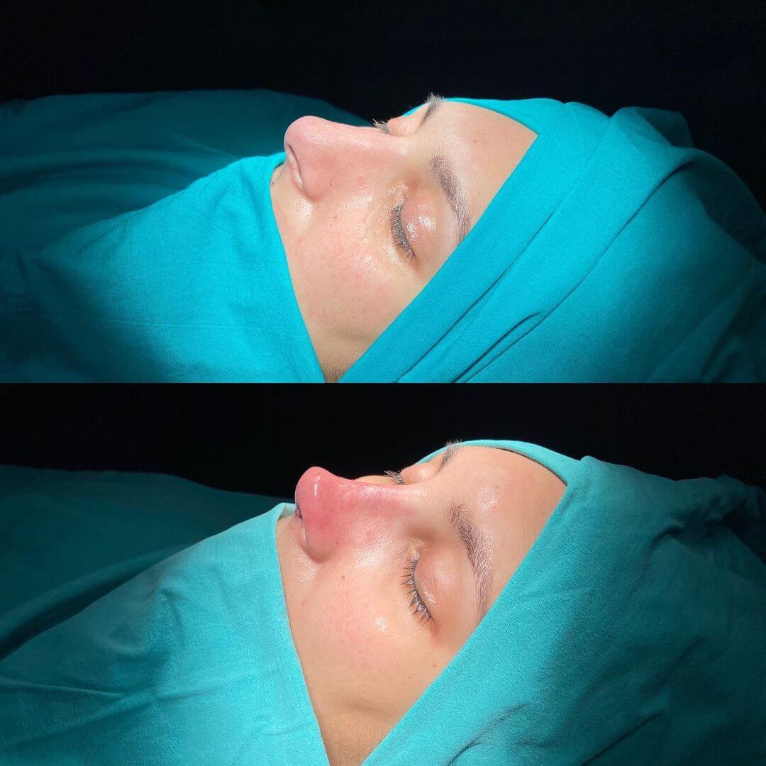 Female Rhinoplasty 2-2