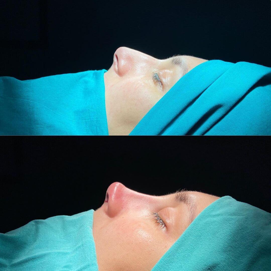Female Rhinoplasty 2-3