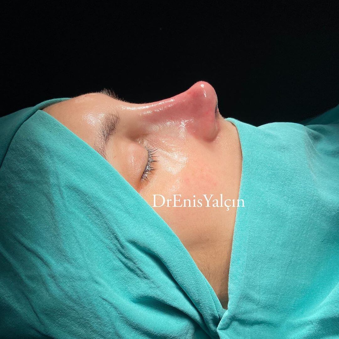 Female Rhinoplasty 2-4