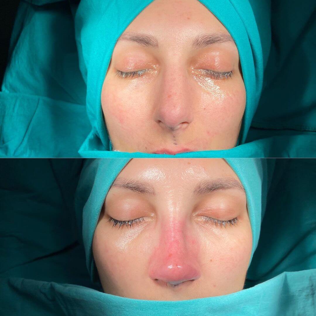 Female Rhinoplasty 2-5