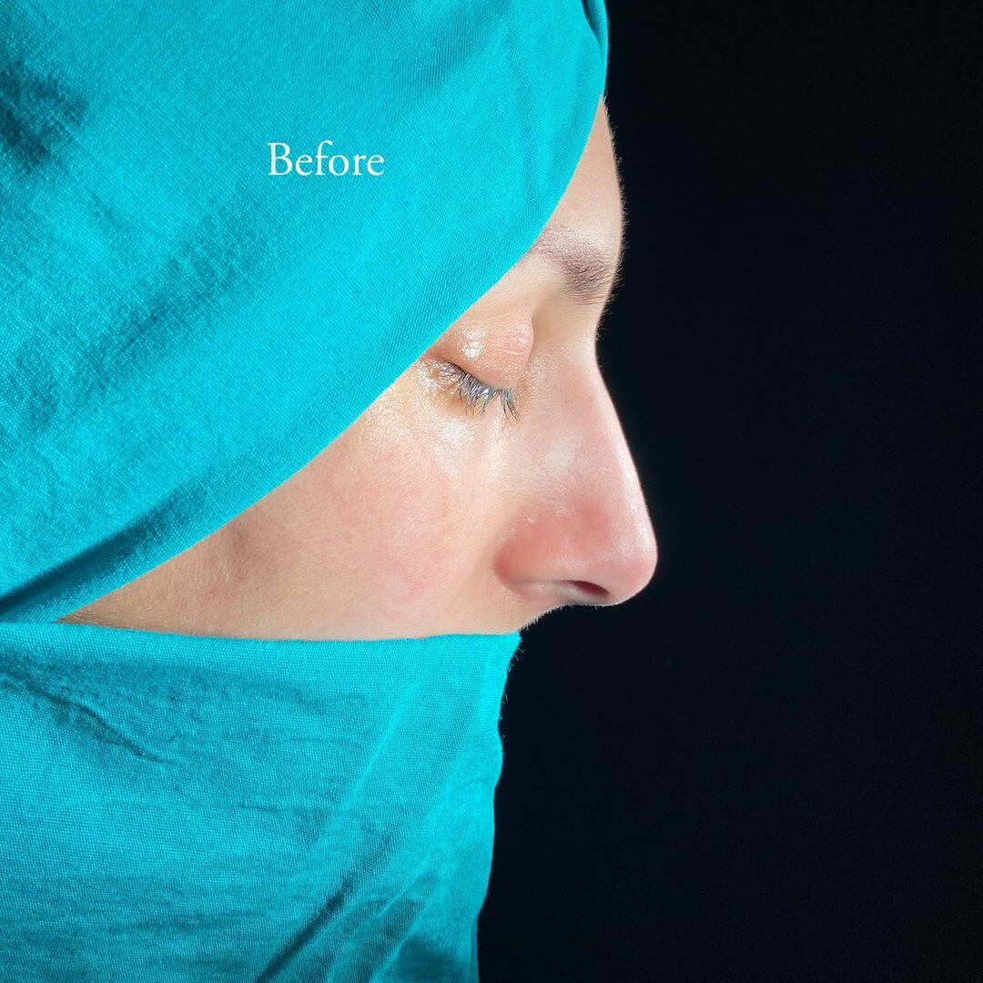Female Rhinoplasty 2-6