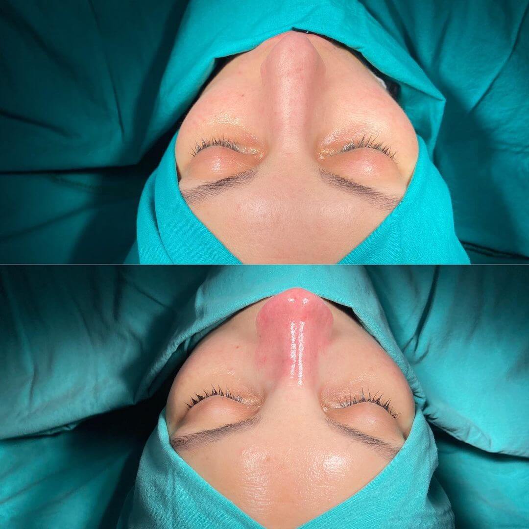 Female Rhinoplasty 2-7
