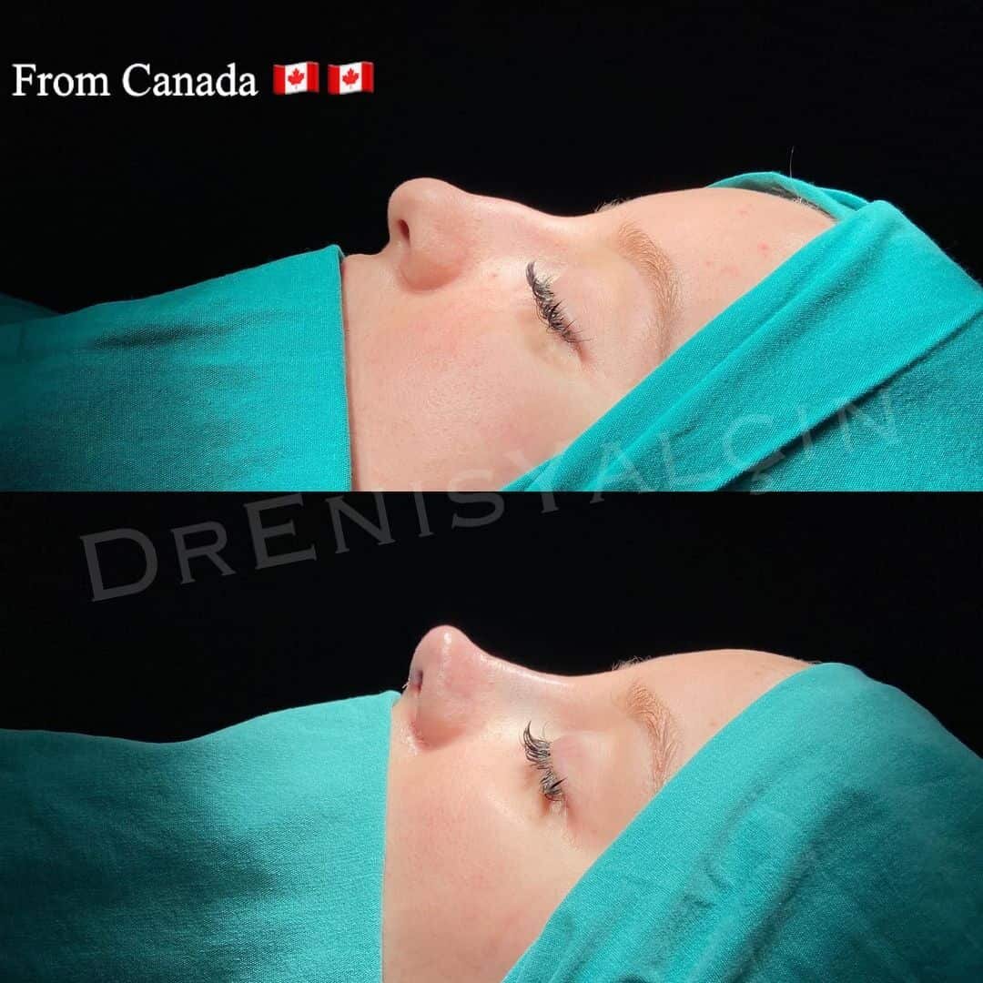 Female Rhinoplasty 3-1