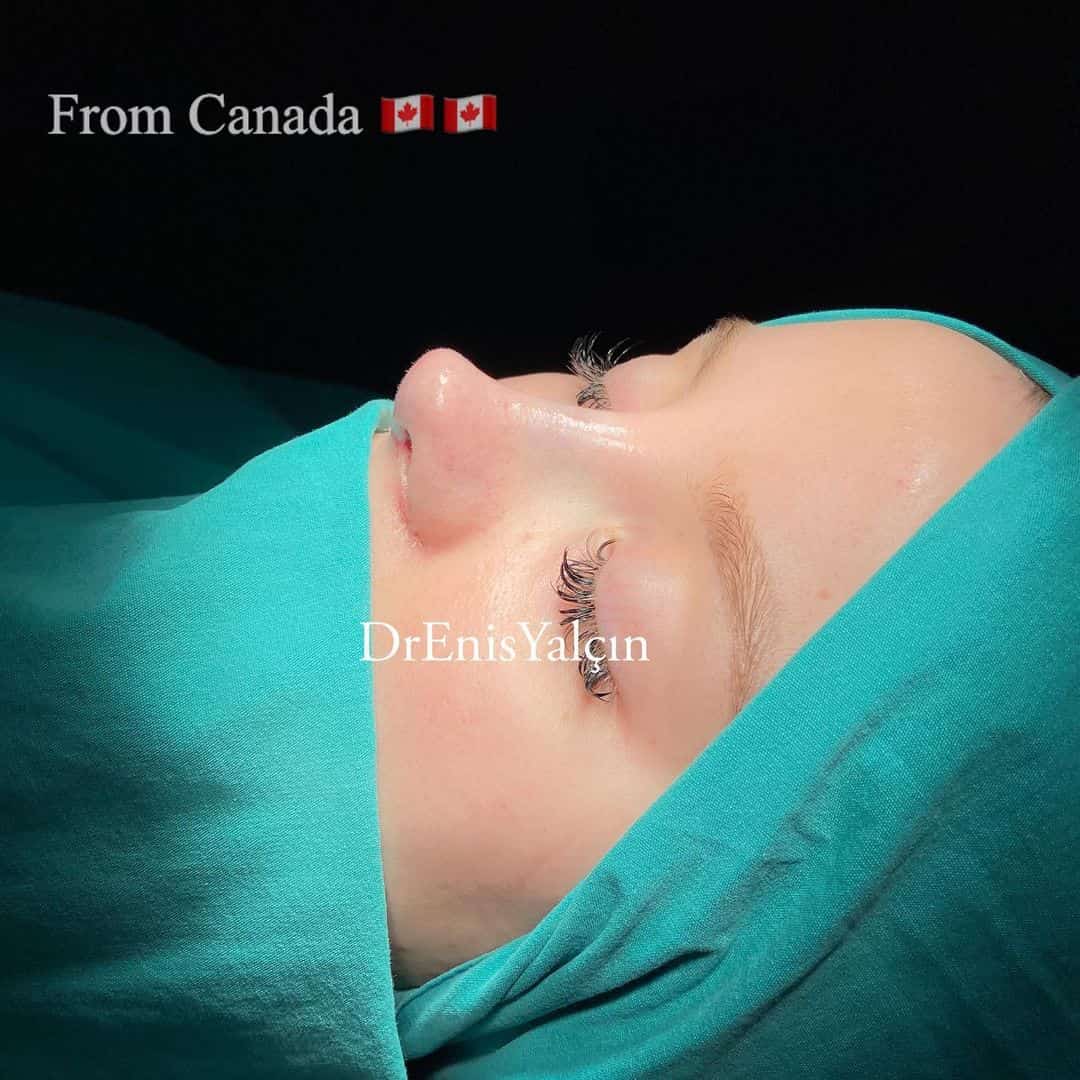 Female Rhinoplasty 3-2