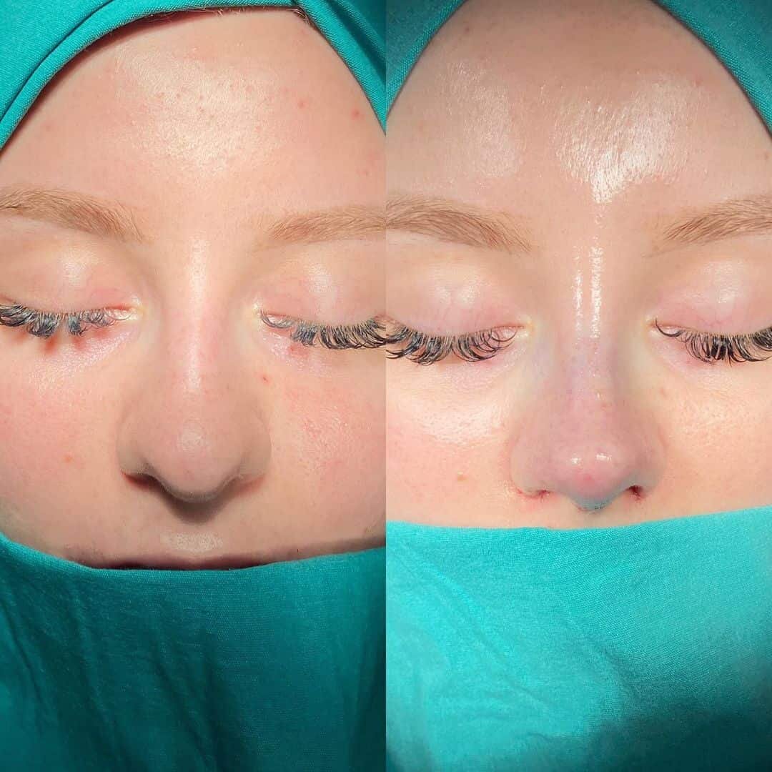 Female Rhinoplasty 3-3