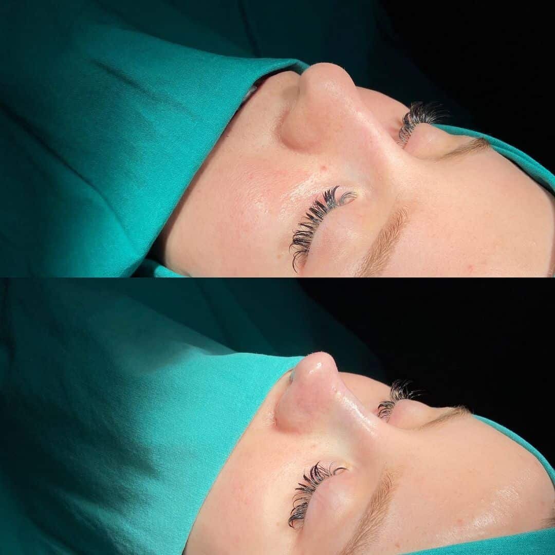 Female Rhinoplasty 3-4