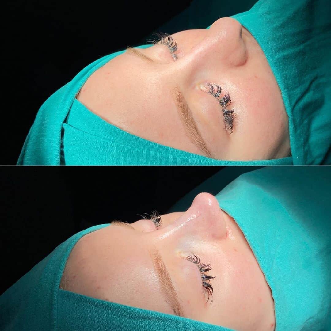 Female Rhinoplasty 3-5