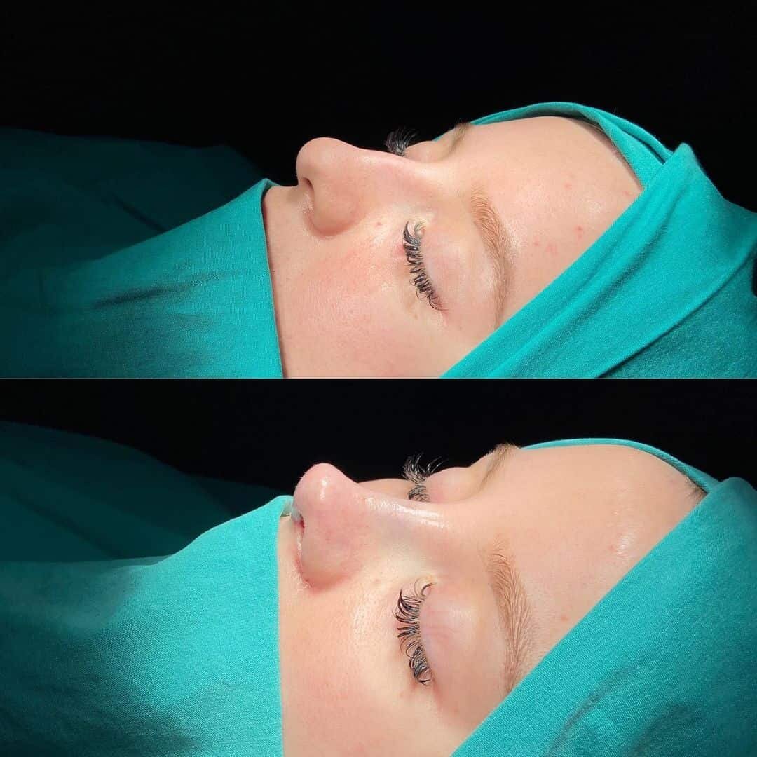 Female Rhinoplasty 3-6