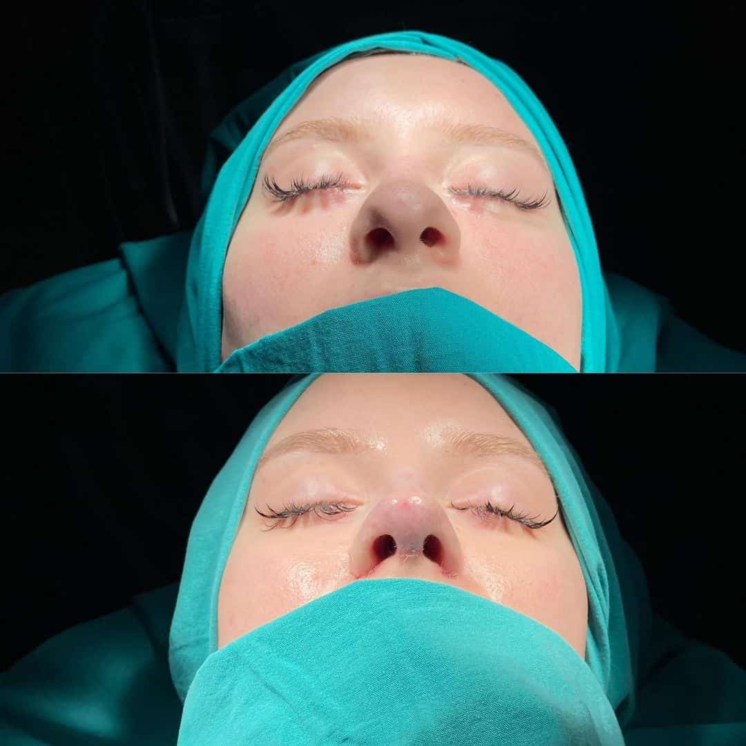 Female Rhinoplasty 3-7