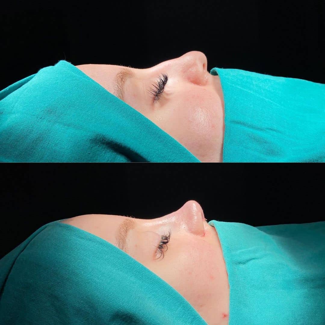 Female Rhinoplasty 3-8