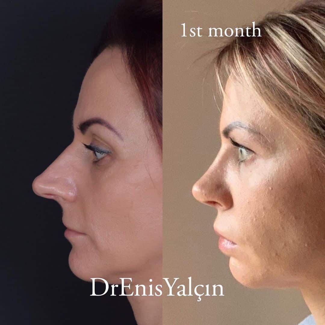 Female Rhinoplasty 4-1