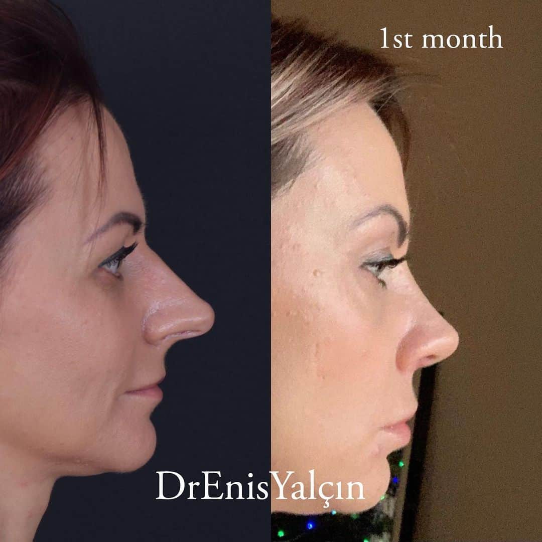 Female Rhinoplasty 4-2
