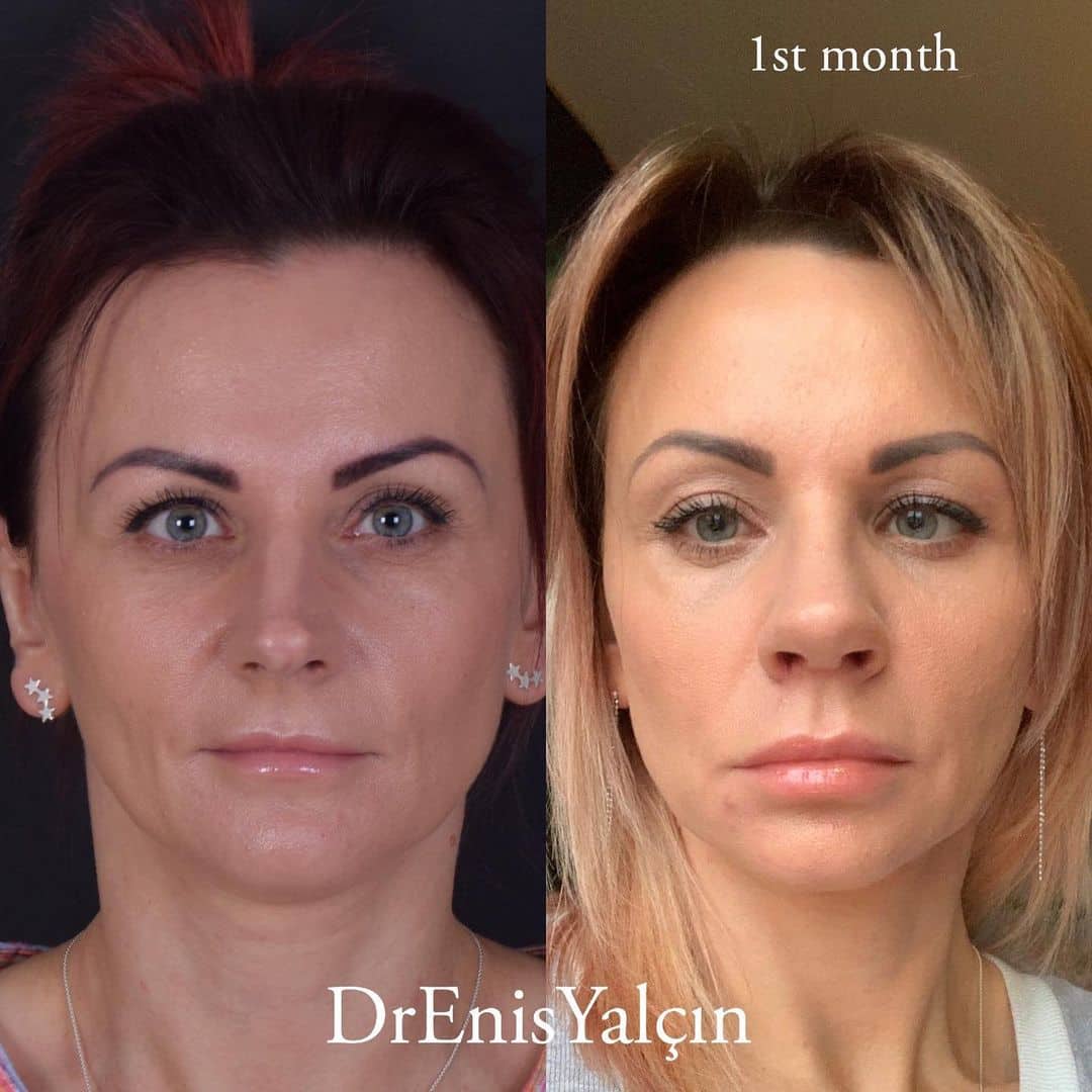 Female Rhinoplasty 4-3