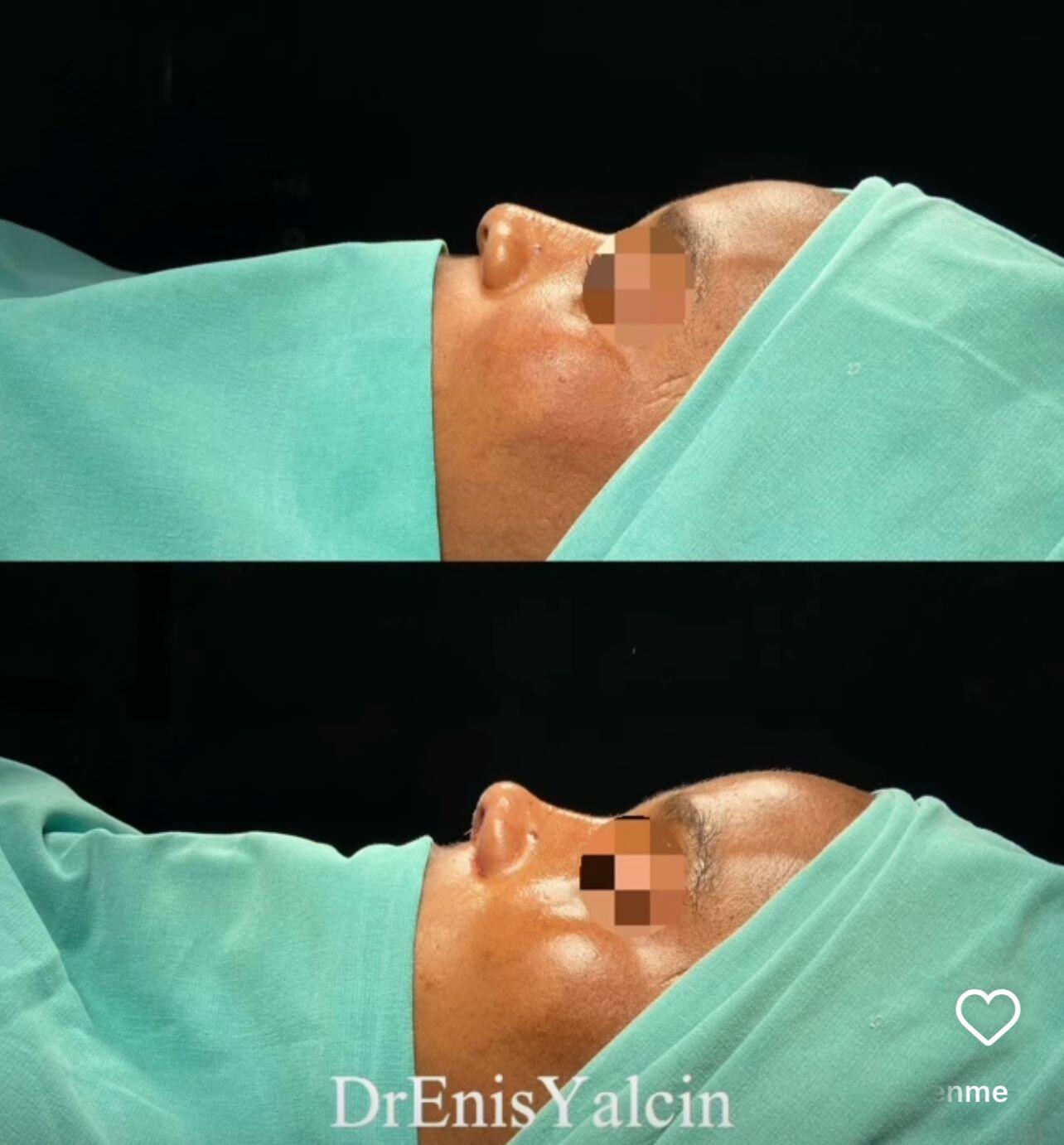Female Rhinoplasty 5-1