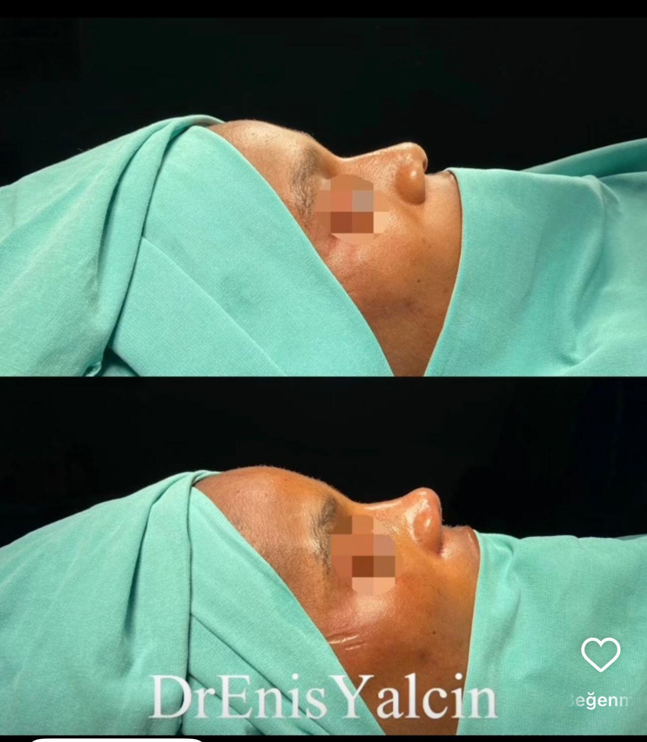 Female Rhinoplasty 5-2