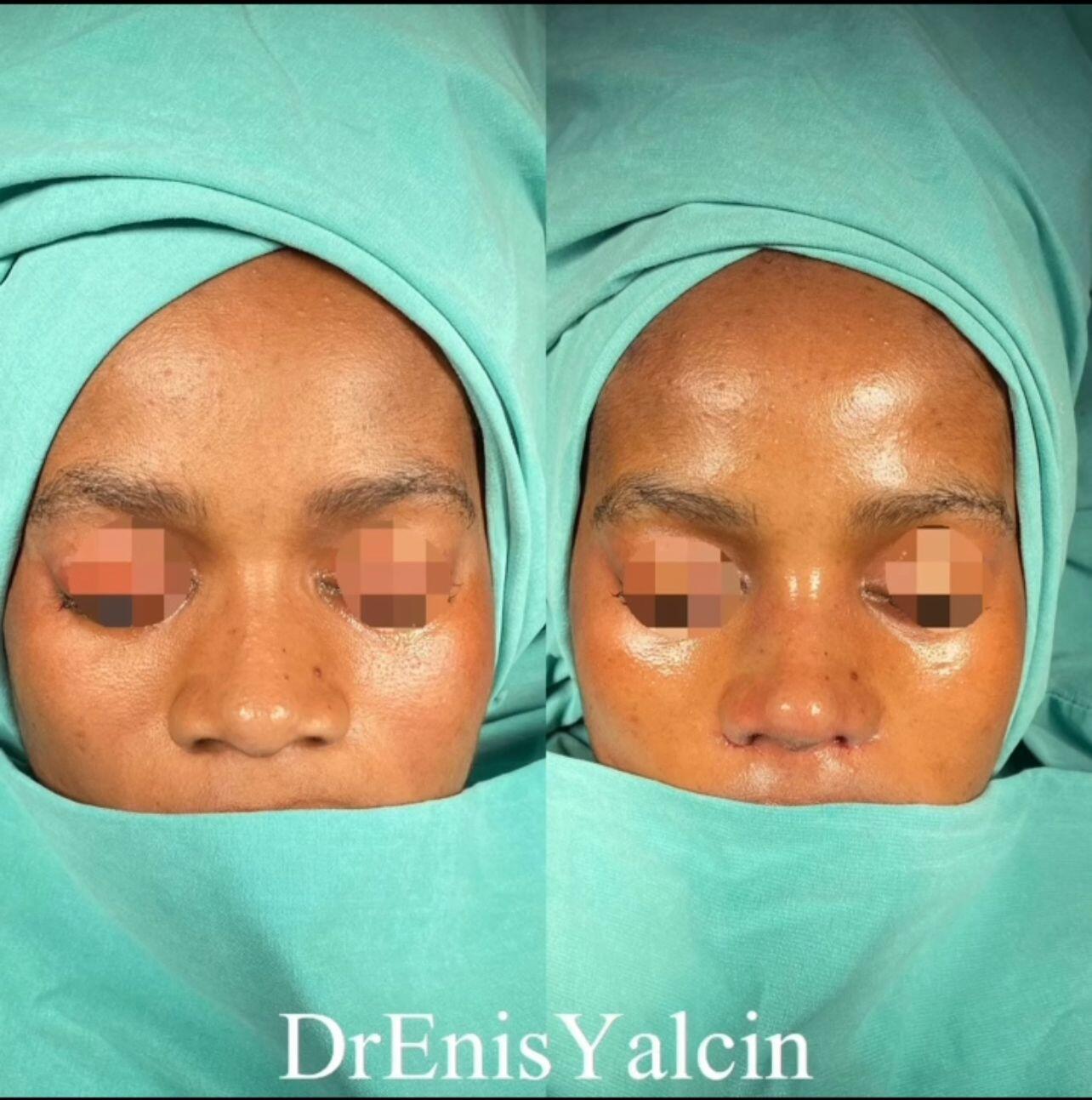 Female Rhinoplasty 5-3