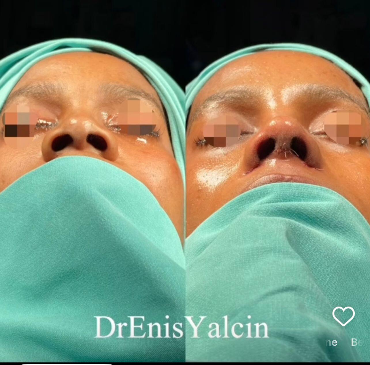 Female Rhinoplasty 5-4