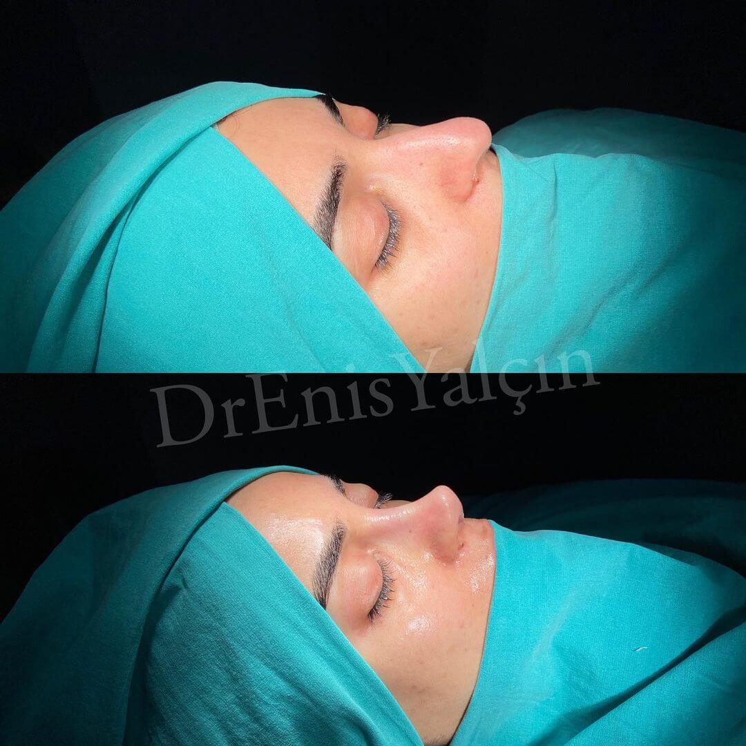 Female Rhinoplasty 6-1