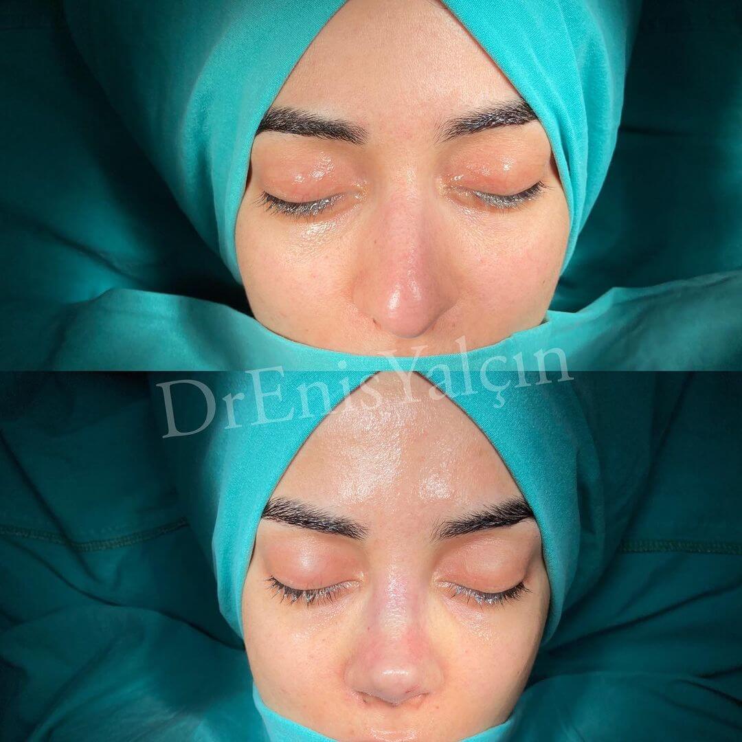 Female Rhinoplasty 6-2