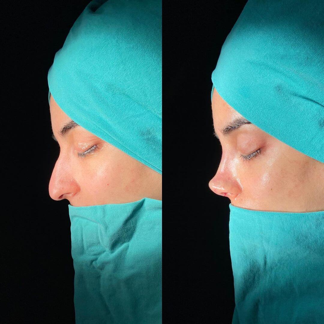 Female Rhinoplasty 6-3