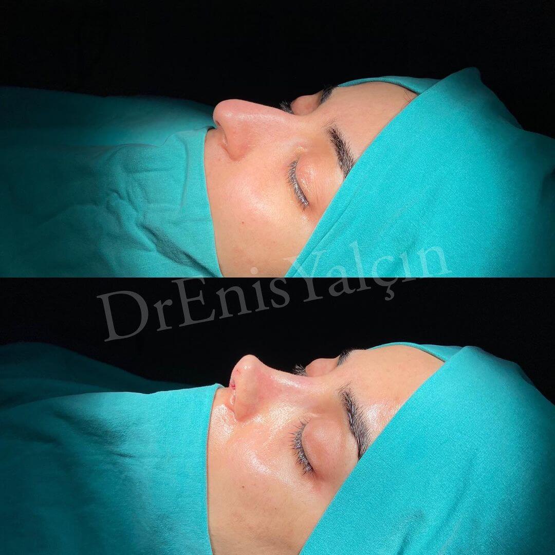 Female Rhinoplasty 6-4