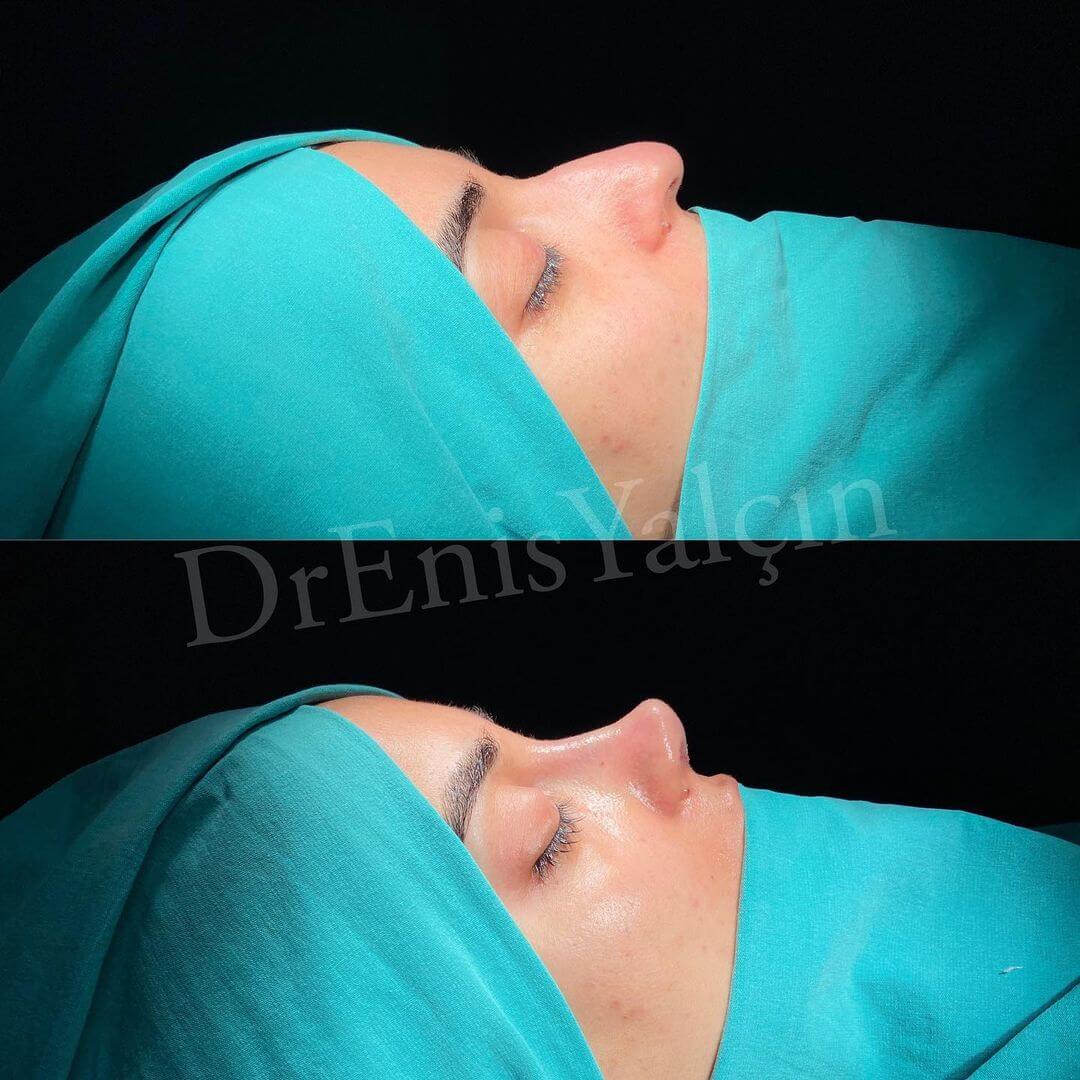 Female Rhinoplasty 6-5