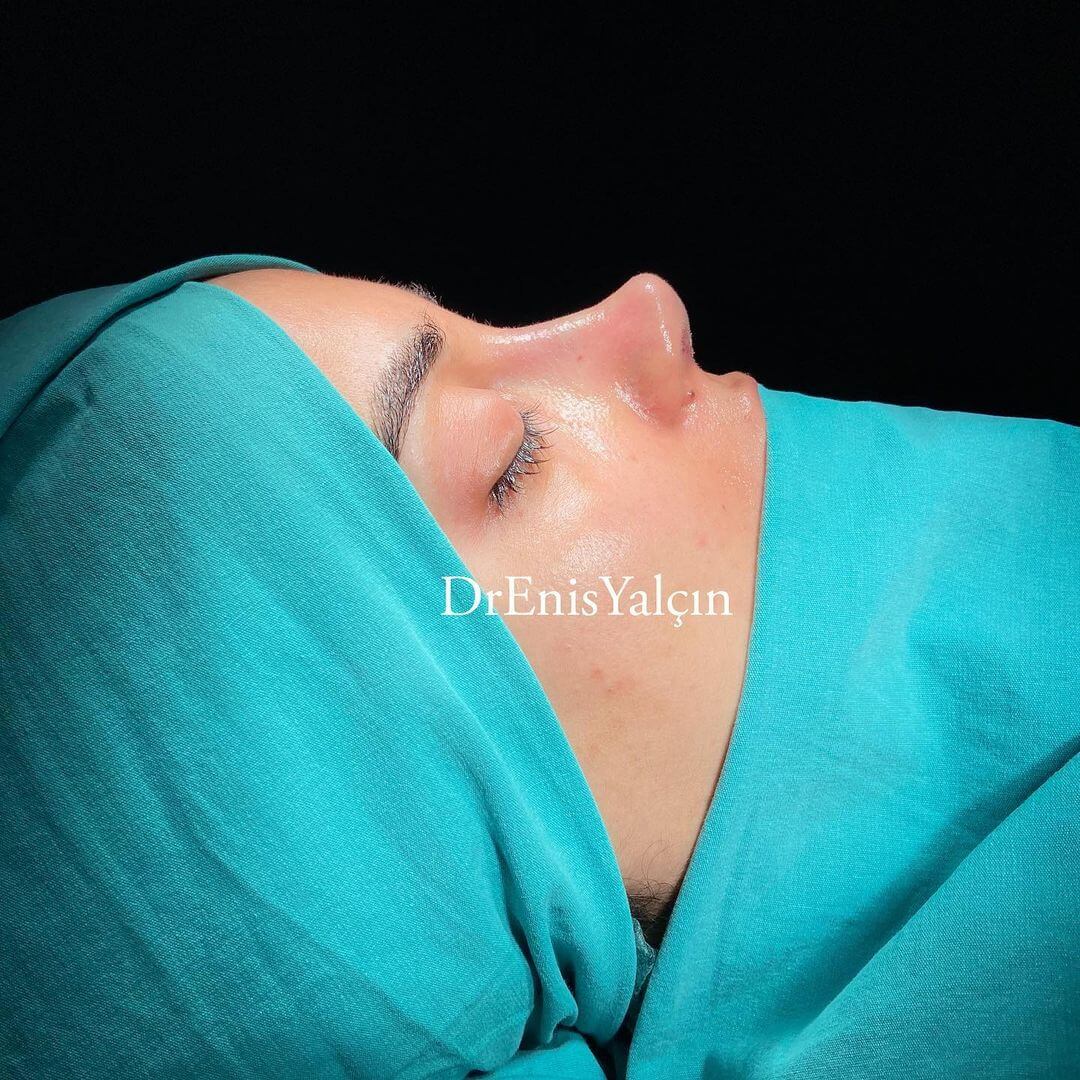Female Rhinoplasty 6-6