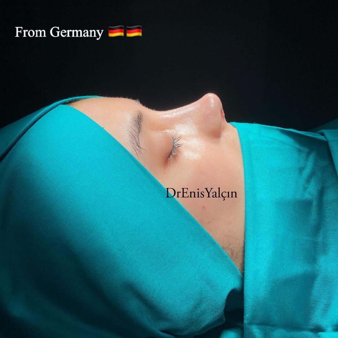Female Rhinoplasty 7-1