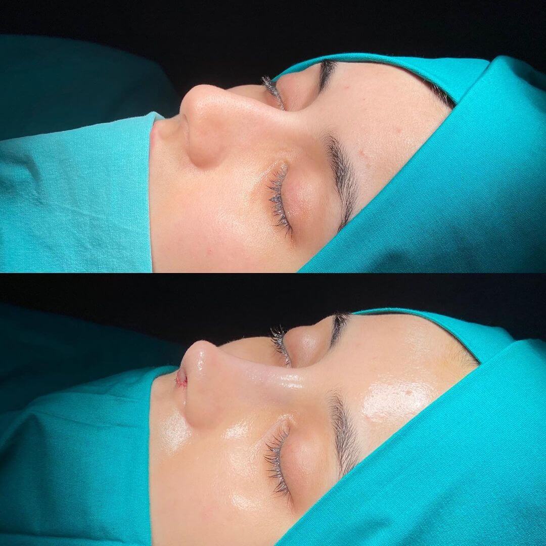 Female Rhinoplasty 7-2