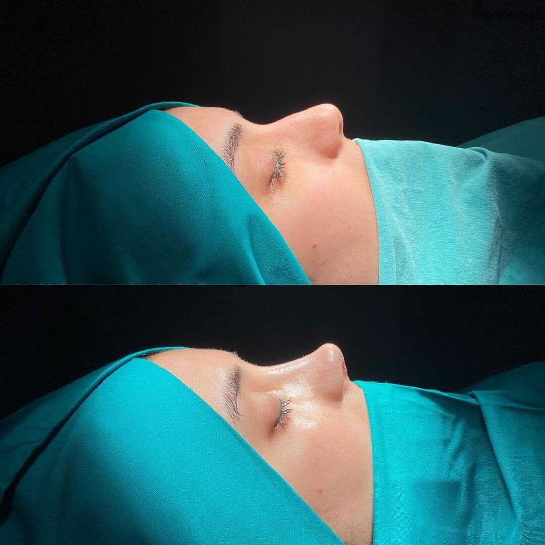 Female Rhinoplasty 7-3