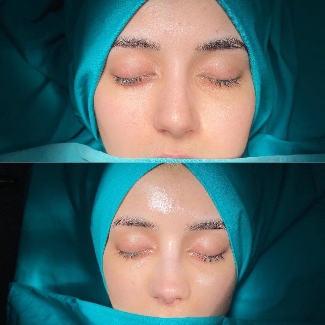 Female Rhinoplasty 7-4