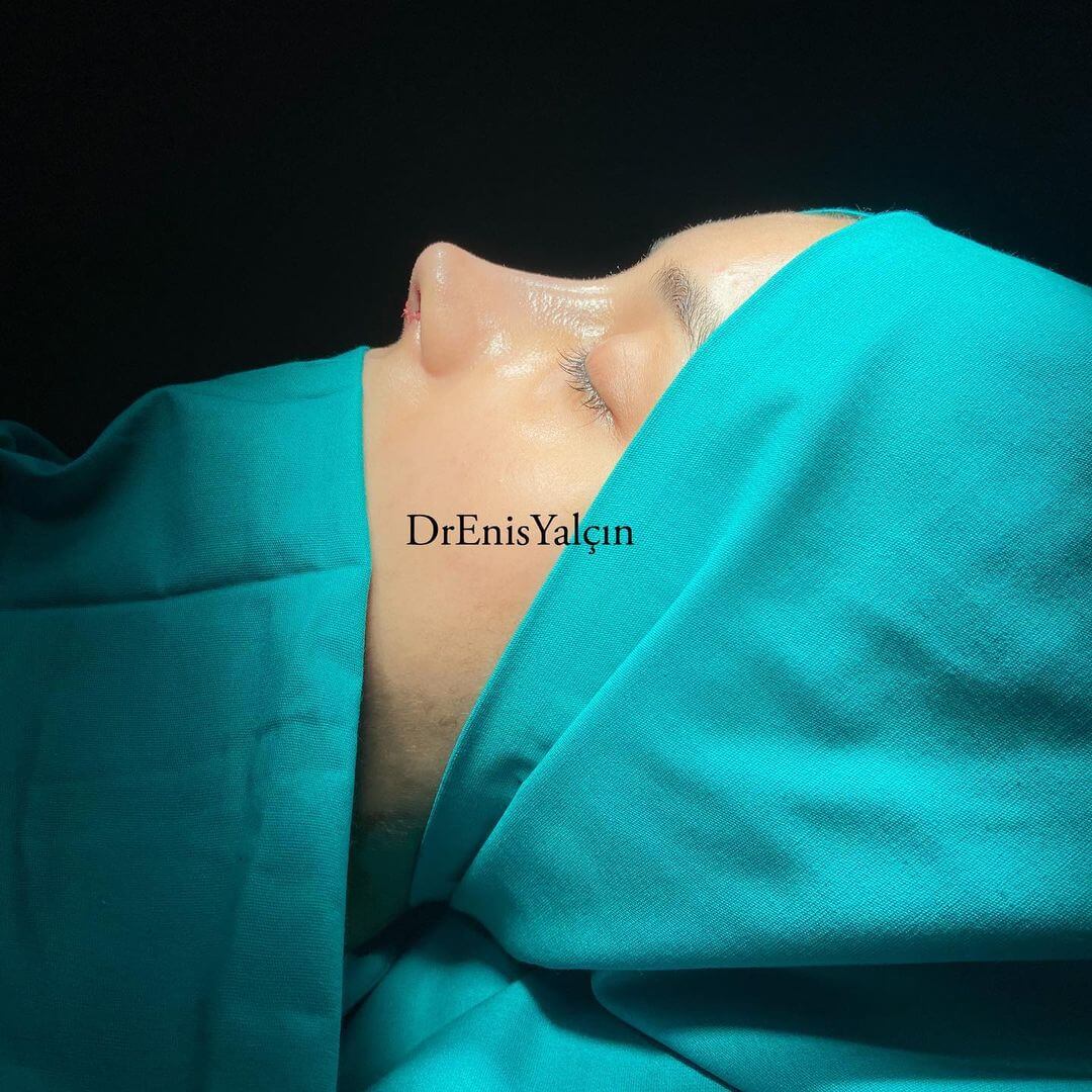 Female Rhinoplasty 7-6