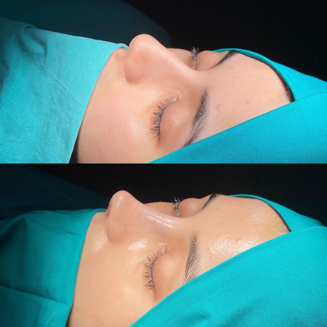 Female Rhinoplasty 7-7