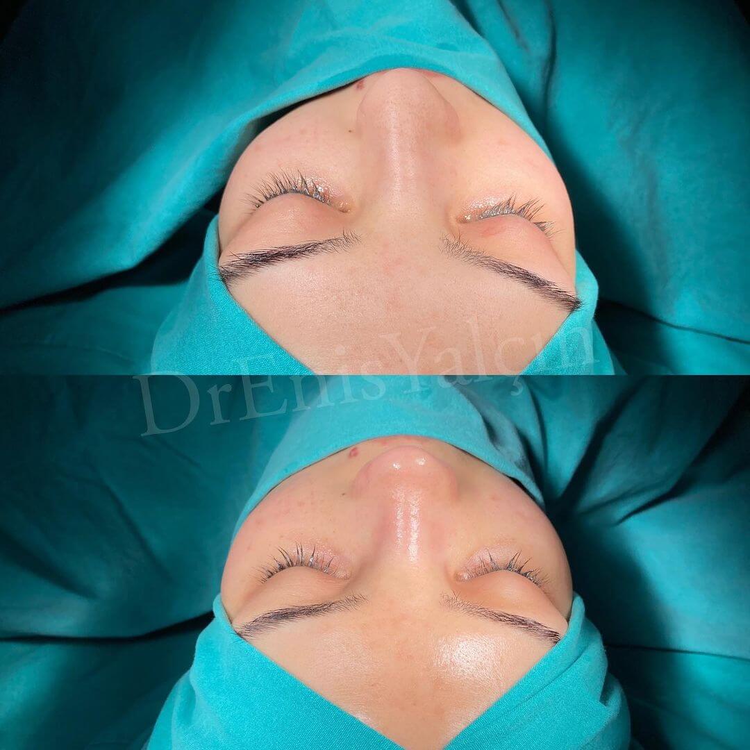Female Rhinoplasty 8-1