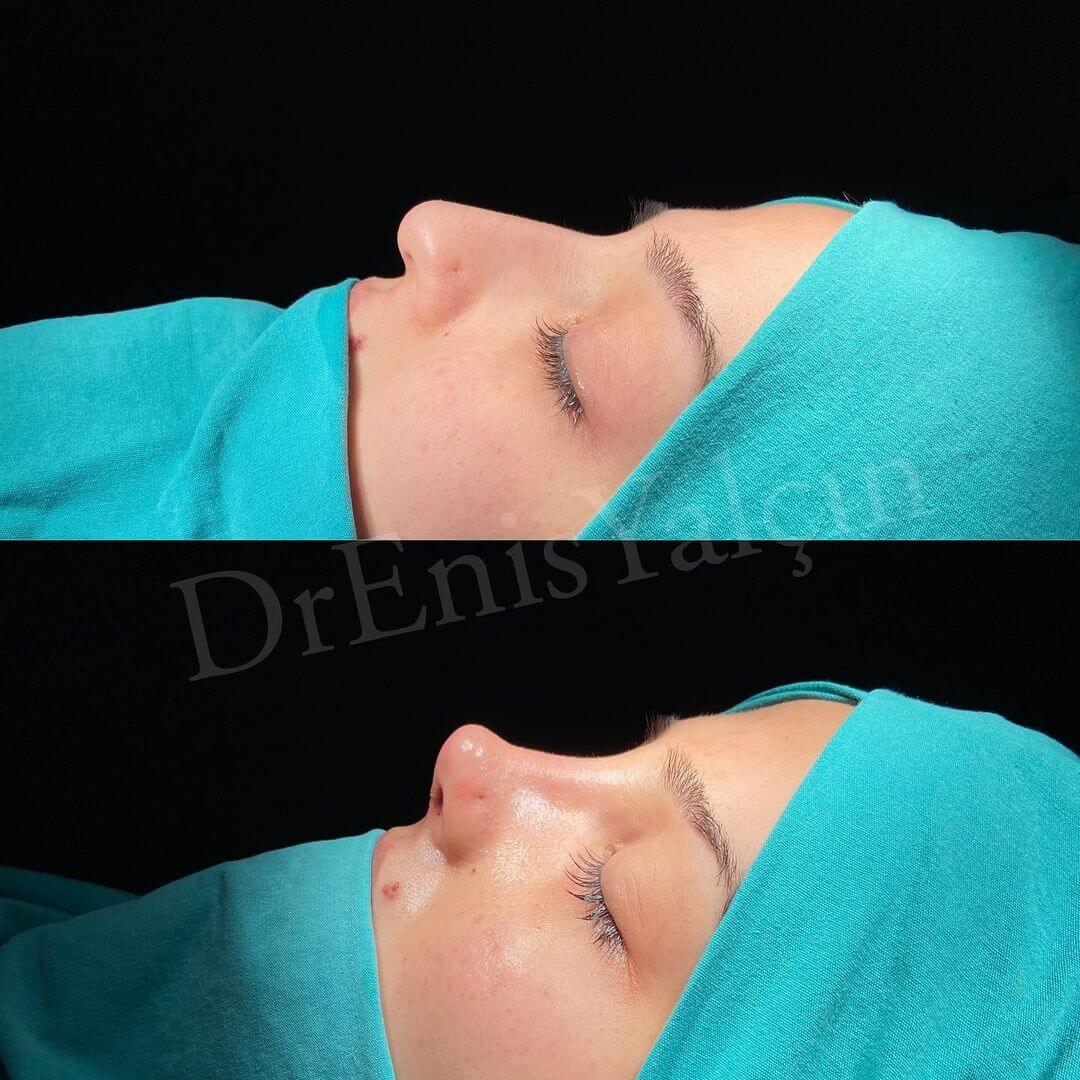 Female Rhinoplasty 8-2