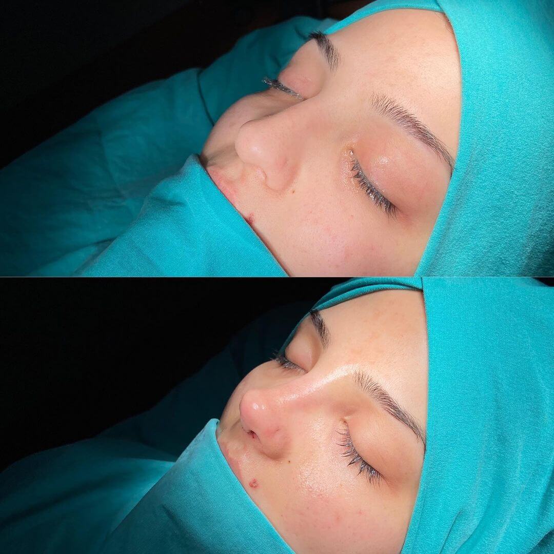 Female Rhinoplasty 8-4