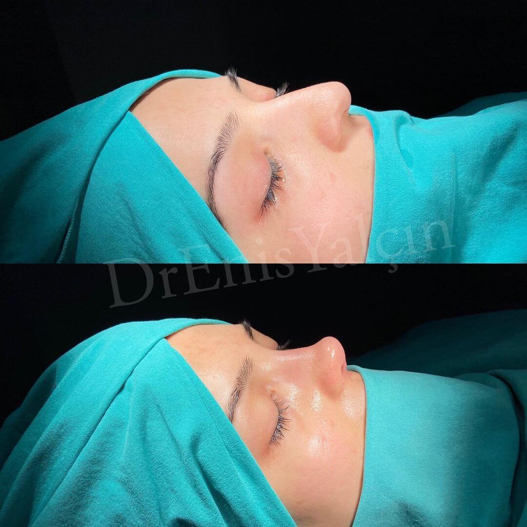 Female Rhinoplasty 8-5