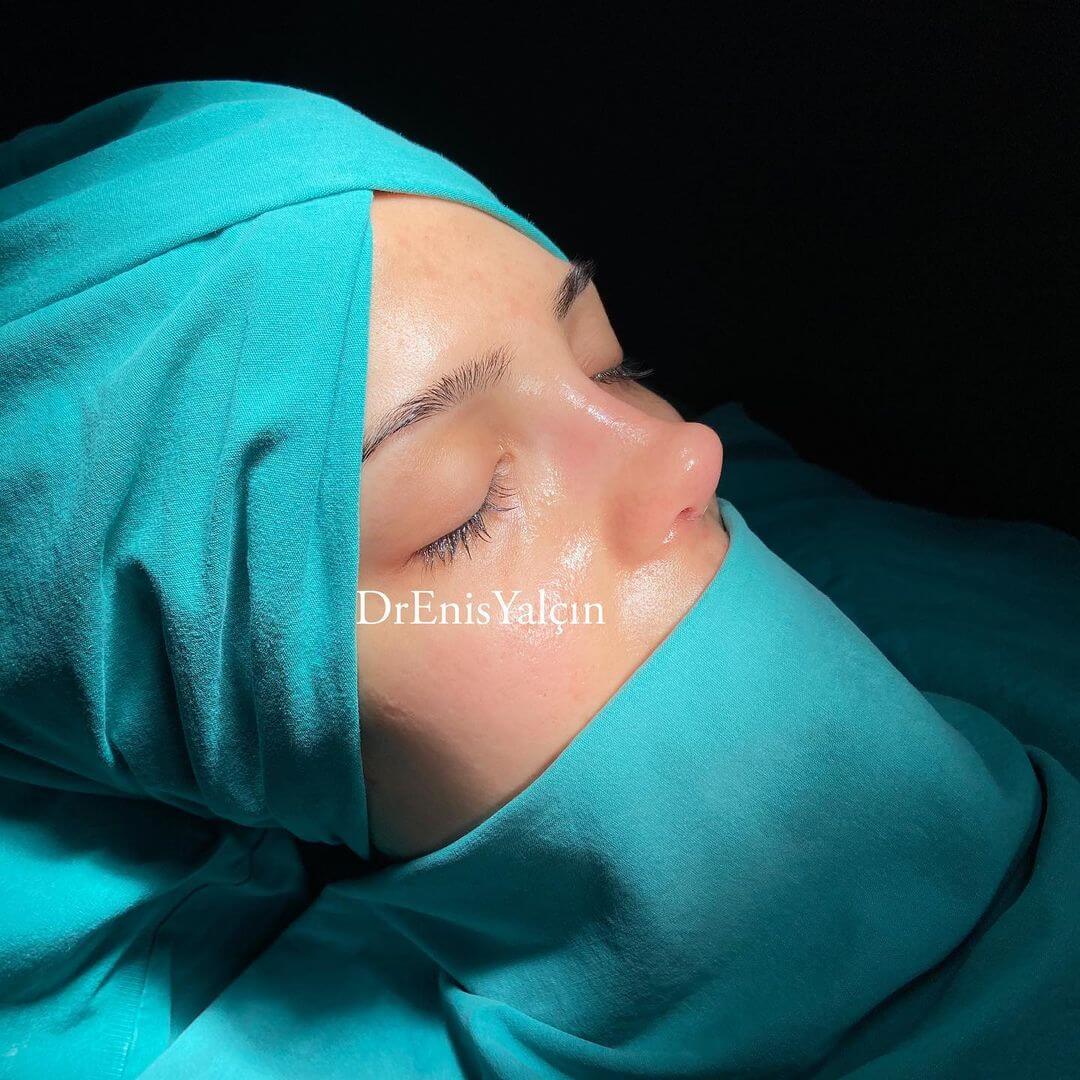 Female Rhinoplasty 8-6