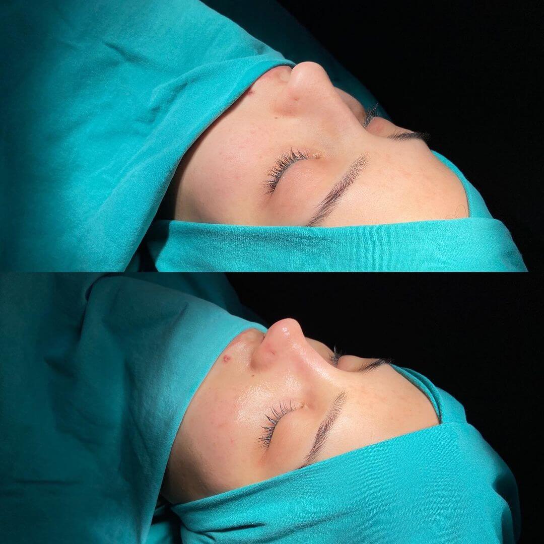 Female Rhinoplasty 8-7