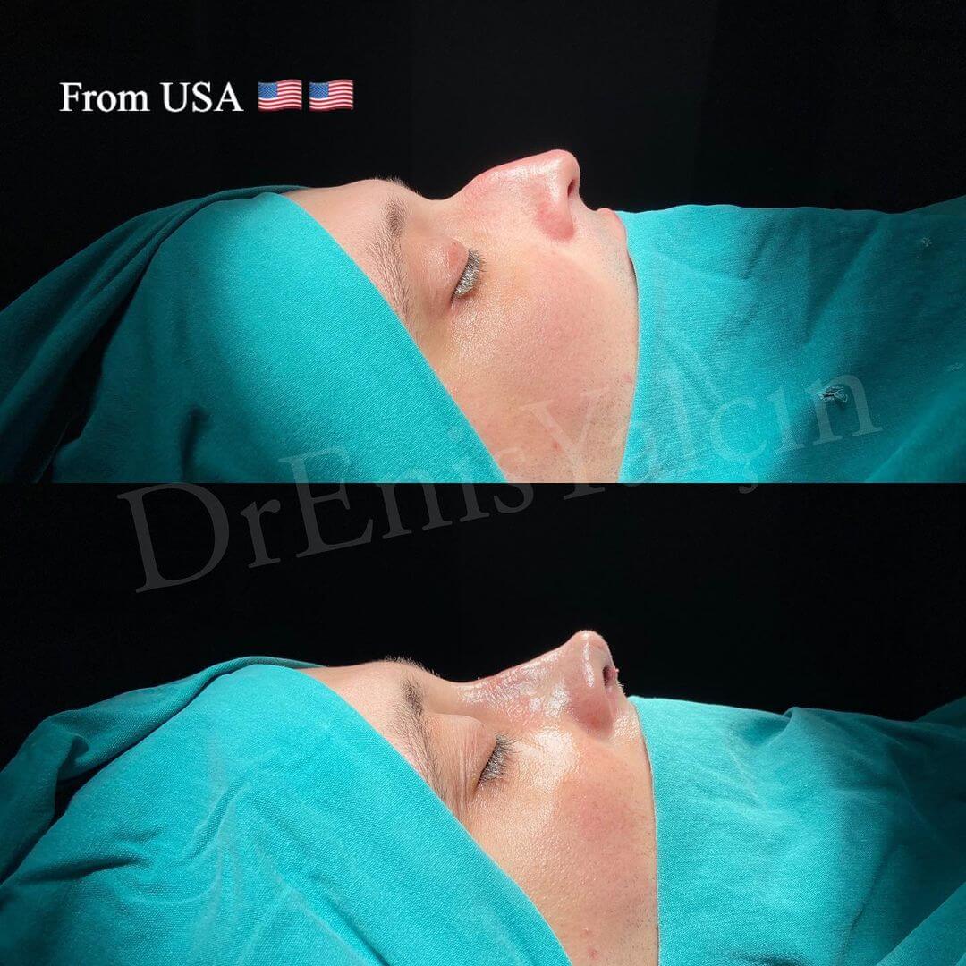 Male Rhinoplasty 1-1