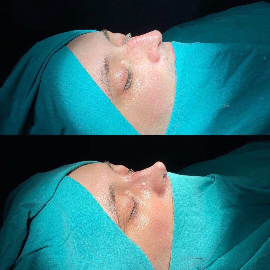Male Rhinoplasty 1-2